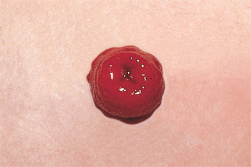 Photo of a healthy stoma. It is bright red and roughly the diameter of a quarter. The ostomate is caucasian.