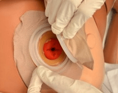 Shows skin barrier being applied by a latex gloved hand to a white abdomen around a bright red stoma